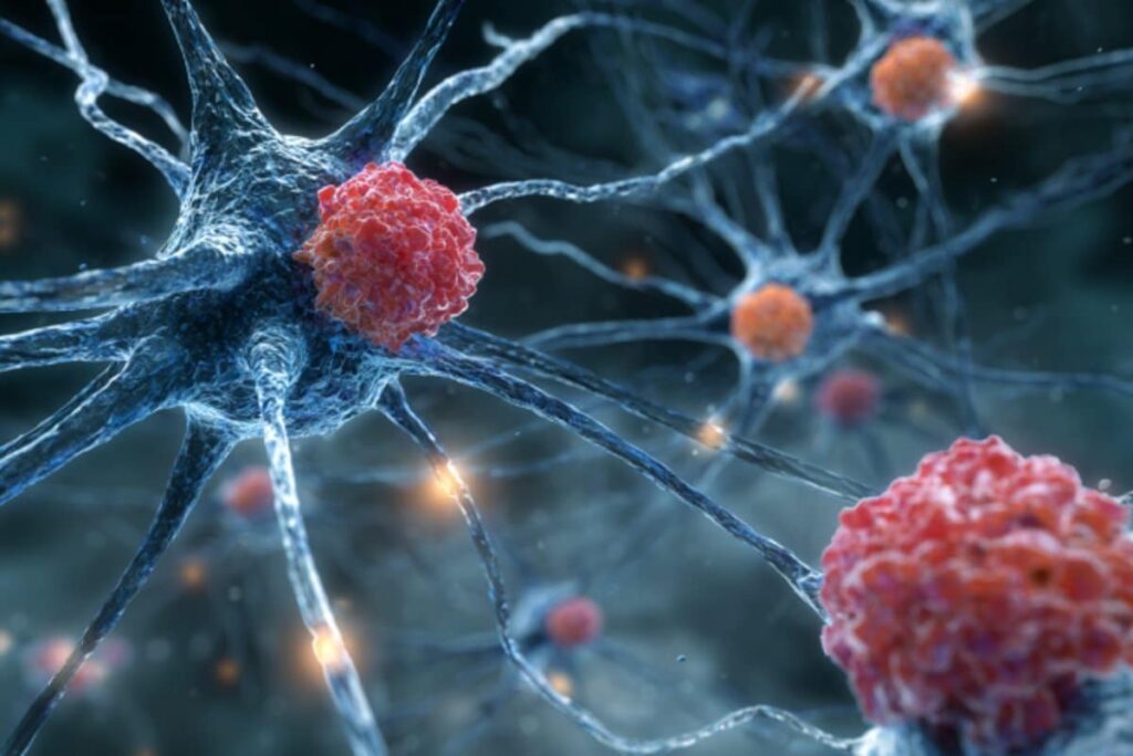 ALS May Be an Autoimmune Disease ALS May Be an Autoimmune Disease